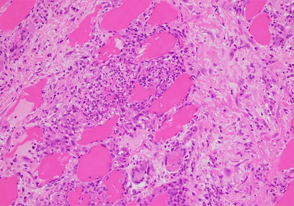 【J9集团助力】医治结节病的KBMAB-16获FDA核准临床